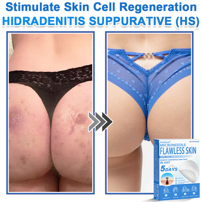📌 Awzlove® 2-in-1 Microneedle & Hydrocolloid Patch | Raised Moles,Acne,  Flat Warts & Skin Tags Remover | Improves Wrinkles, Scars & Blemishes | Invisible Star Pimple Patches for Face & Body | 🎁🎁8