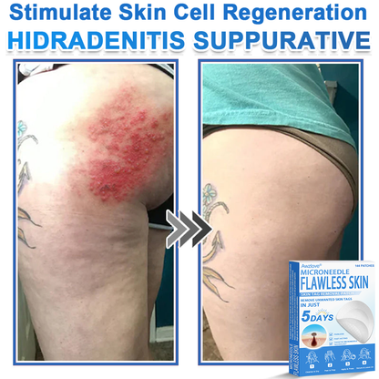 📌 Awzlove® 2-in-1 Microneedle & Hydrocolloid Patch | Raised Moles,Acne,  Flat Warts & Skin Tags Remover | Improves Wrinkles, Scars & Blemishes | Invisible Star Pimple Patches for Face & Body | 🎁🎁8